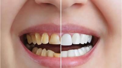 तुमचे दात मोत्यांसारखे चमकतील, फक्त ही एक गोष्ट तुमच्या टूथपेस्टमध्ये करा मिक्स