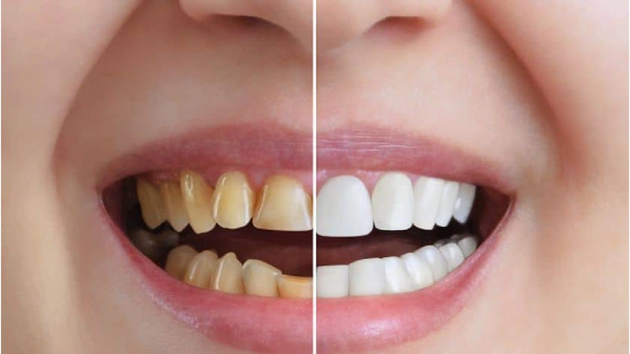 तुमचे दात मोत्यांसारखे चमकतील, फक्त 'ही' एक गोष्ट तुमच्या टूथपेस्टमध्ये करा मिक्स