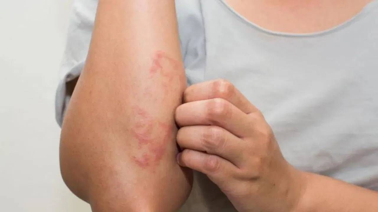  व्हिटॅमिन डीच्या कमतरतेने दुसरे एक मोठे कारण असे दिसून येते की, त्वचा मोठ्या प्रमाणात कोरडी पडते. जर ही लक्षणे दिसत असतील तर आजच डॉक्टरांचा सल्ला घ्या. 