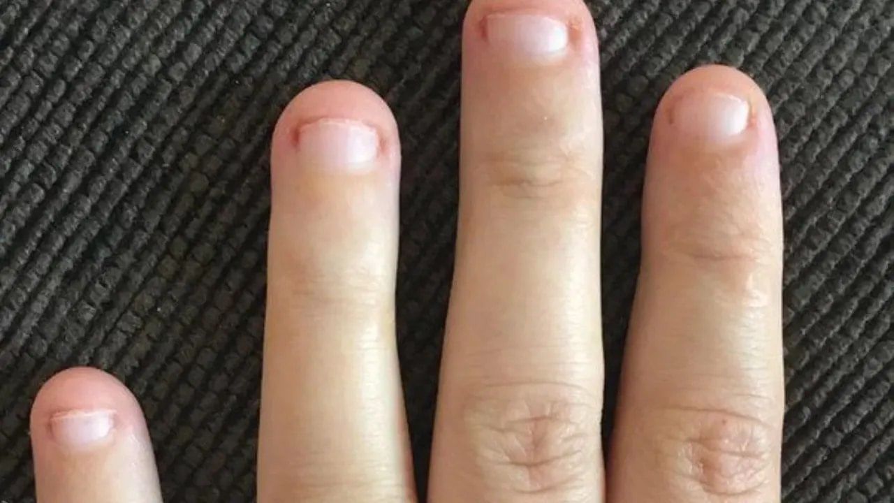 nail biting 2
