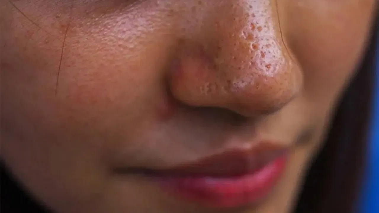 चेहऱ्यावरील तेलामुळे पिगमेंटेशनच्या समस्या? घरच्या घरी ट्राय करा 'या' सोप्या टिप्स...