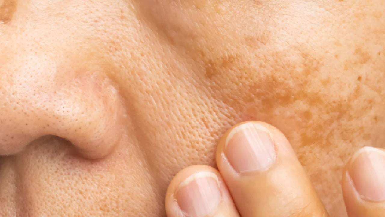 चेहऱ्यावरील काळे डाग कमी करण्यासाठी दालचिनीचा ‘या’ पद्धतीनं करा वापर