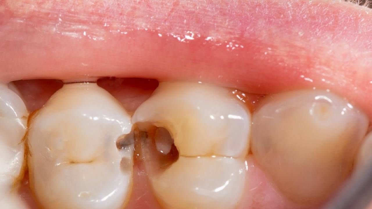 मजबूत आणि चमकदार दातांसाठी सर्वात महत्वाचे आहे की, दररोज स्वच्छ दात साफ केली पाहिजेत. तेव्हाही आपण काही खातो, त्यावेळी दातांवर आणि हिरड्यांवर त्याचा परिणाम होतो. 