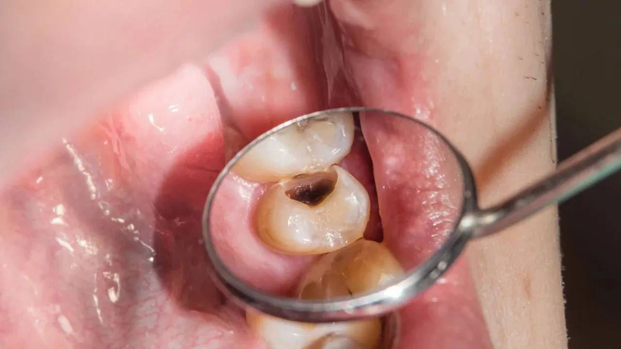  शिवाय जास्त थंड आणि गरम खाद्यपदार्थ खाणे टाळा. यामुळे आपल्या दातांना ईजा होते. कमकुवत हिरड्या होण्याचा धोका अधिक वाढतो, या गोष्टी फॉलो केल्या तर दातांची समस्या कधीच होणार नाही. 