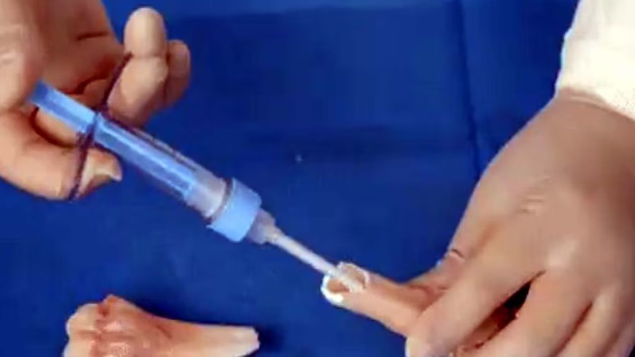 अवघ्या काही मिनिटात तुटलेली हाडे जोडली जाणार... जगातील पहिला बोन ग्लू तयार