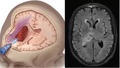 ब्रेन स्ट्रोक येण्याआधी एक दिवस आधी शरीर देते हे संकेत, दुलर्क्ष केल्यास येतो अटॅक
