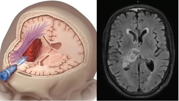 ब्रेन स्ट्रोक येण्याआधी एक दिवस आधी शरीर देते हे संकेत, दुलर्क्ष केल्यास येतो अटॅक ब्रेन स्ट्रोक येण्याआधी एक दिवस आधी शरीर देते हे संकेत, दुलर्क्ष केल्यास येतो अटॅक