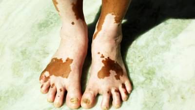 त्वचेवर पांढरे डाग आहेत, घाबरु नका..., तज्ज्ञांकडून जाणून घ्या संपूर्ण माहिती