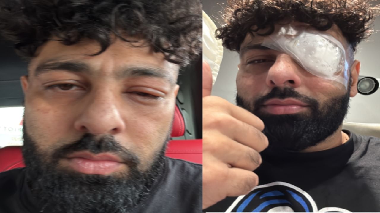 डोळा सुजला, भलं मोठं बॅंडेज, विद्रूप चेहरा; रॅपर बादशाहला नक्की झालंय काय?