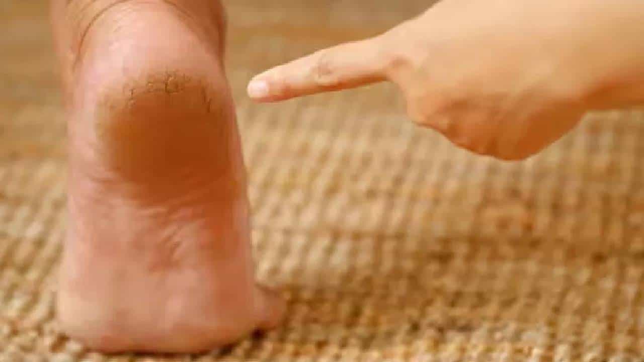 पावसाच्या पाण्यामुळे टाचांना भेगा पडल्या आहेत? तर हे घरगुती उपाय करताच मिळेल आराम