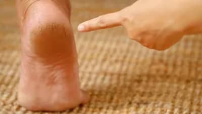 पावसाच्या पाण्यामुळे टाचांना भेगा पडल्या आहेत? तर हे घरगुती उपाय करताच मिळेल आराम