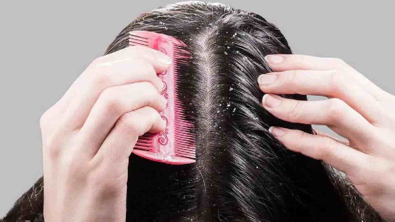 या 3 घरगुती उपायांमुळे कोरड्या स्कॅल्पपासून मिळेल मुक्ती, काही दिवसांतच दिसेल फरक