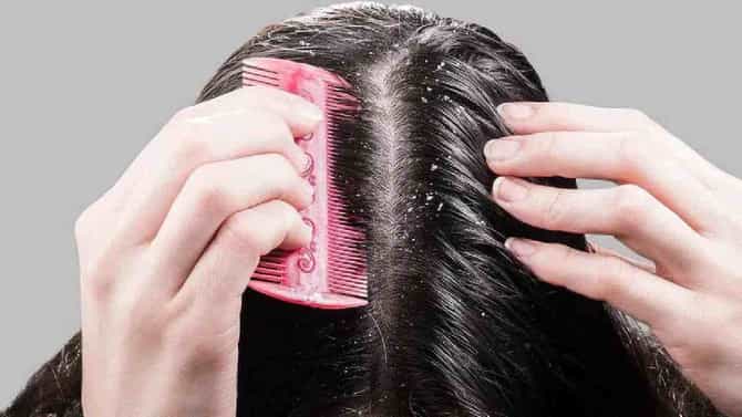 या 3 घरगुती उपायांमुळे कोरड्या स्कॅल्पपासून मिळेल मुक्ती, काही दिवसांतच दिसेल फरक