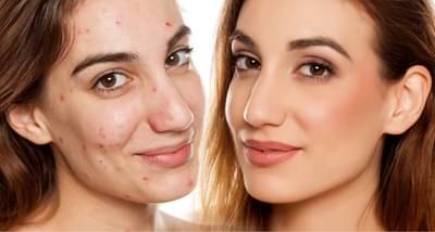 दररोज सकाळी हे सूवर्ण पाणी प्यायल्याने, पिंपल्सच्या समस्या होतील दूर