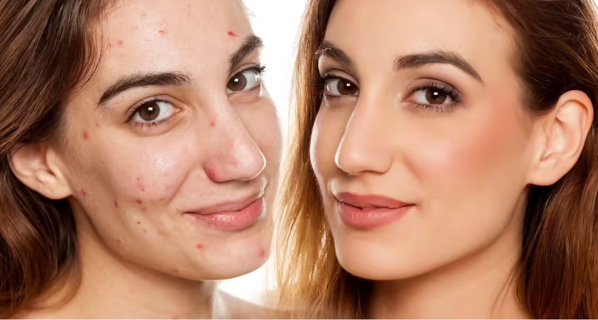 दररोज सकाळी हे 'सूवर्ण' पाणी प्यायल्याने, पिंपल्सच्या समस्या होतील दूर दररोज सकाळी हे 'सूवर्ण' पाणी प्यायल्याने, पिंपल्सच्या समस्या होतील दूर