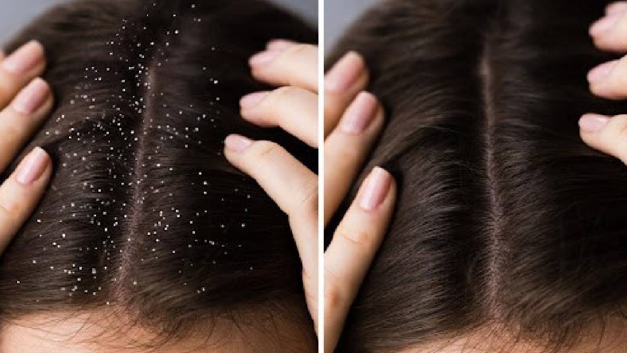 कोंडा दूर करण्यासाठी, नैसर्गिकरित्या केस गळणे थांबवण्यासाठी तेलात 'या' गोष्टी करा मिक्स कोंडा दूर करण्यासाठी, नैसर्गिकरित्या केस गळणे थांबवण्यासाठी तेलात 'या' गोष्टी करा मिक्स