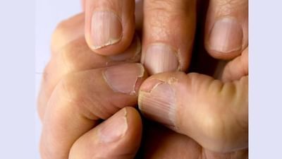 आपल्यापैकी अनेकांची नखं ही वारंवार तुटत असतात. कधीकधी ती कमकुवतही होतात. तुमची नखे वारंवार तुटत असतील किंवा कमकुवत झाली असतील, तर याचे कारण तुमच्या शरीराच्या आत लपलेले आहे.