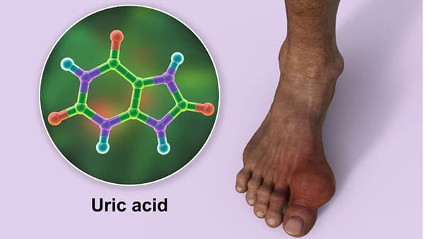 Uric Acid : यूरिक एसिड वाढल्यानंतर काय लक्षणे दिसतात? कशी काळजी घ्यावी ?