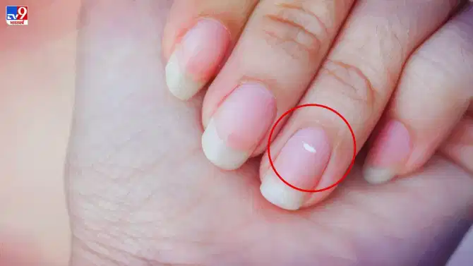 White Spots on Nails: नखांवरील पांढऱ्या डागांचे नशीबाशी आहे खास कनेक्शन, वाचा नेमकं काय?