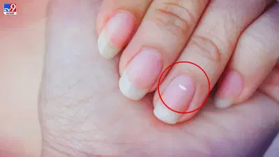 White Spots on Nails: नखांवरील पांढऱ्या डागांचे नशीबाशी आहे खास कनेक्शन, वाचा नेमकं काय?