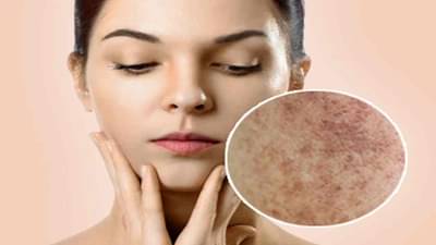 चेहऱ्यावरील काळ डाग होतील छूमंतर.... या तेलाचा करा योग्य पद्धतीनं वापर