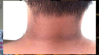 मानेवरील काळपटपणा होईल दूर...हा घरगुती उपाय नक्की ट्राय करा