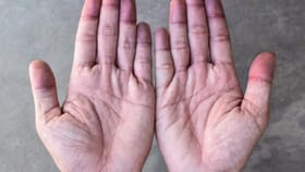 शरीरात 'या' गोष्टीची कमतरता असल्यास थंडीत हाता-पायांची बोटं होतात निळी.