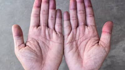 शरीरात या गोष्टीची कमतरता असल्यास थंडीच्या दिवसात हाता-पायांची बोटं पडतात निळी