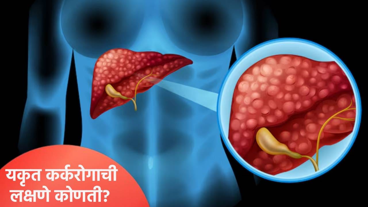लिव्हर कॅन्सरची लक्षणे कोणती आहेत? उपायांसह जाणून घ्या