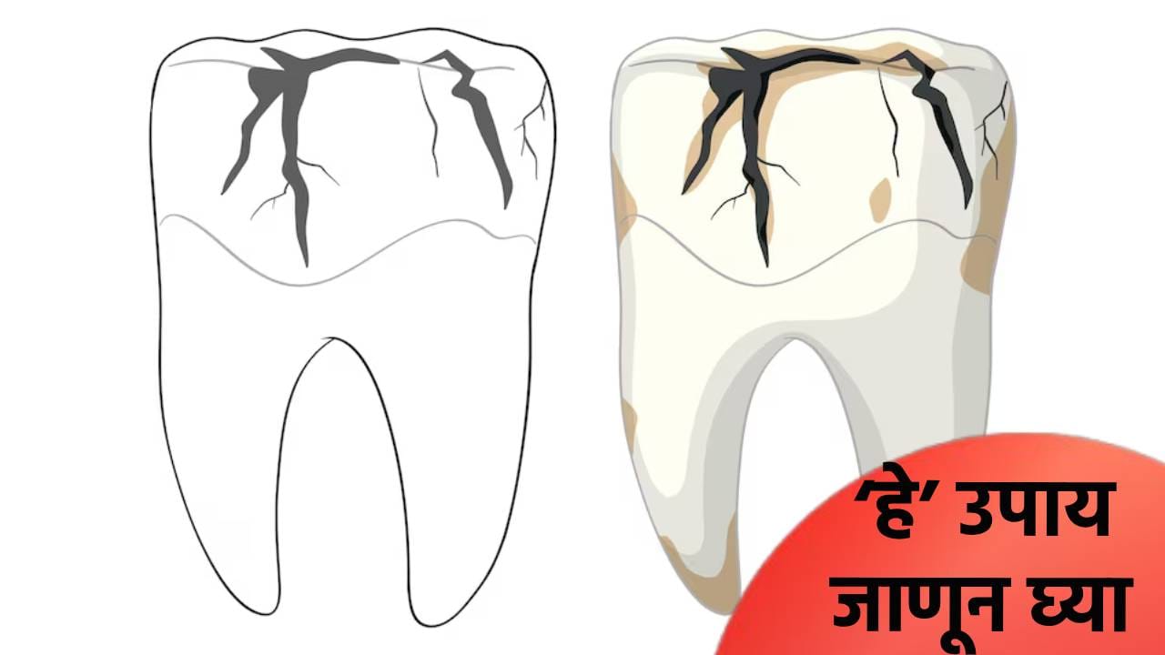 दात पूर्ण किडले का? अन्न अडकते का? डॉक्टरांनी सांगितले ‘हे’ उपाय, जाणून घ्या