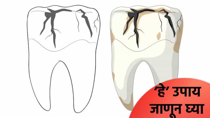 दात पूर्ण किडले का? अन्न अडकते का? डॉक्टरांनी सांगितले ‘हे’ उपाय, जाणून घ्या