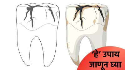 दात पूर्ण किडले का? अन्न अडकते का? डॉक्टरांनी सांगितले ‘हे’ उपाय, जाणून घ्या