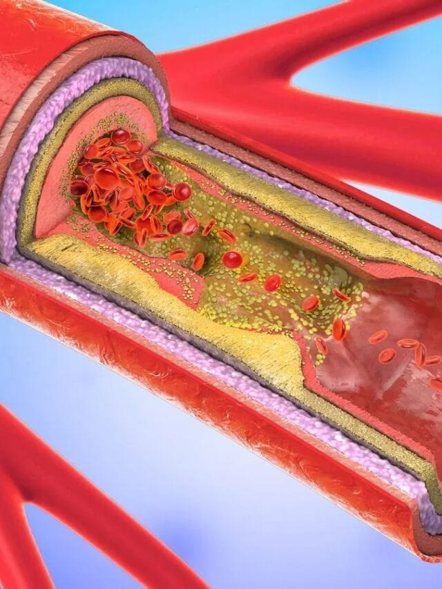 शरीरातील खराब कोलेस्ट्रॉल कोणत्या पदार्थांमुळे वाढते?