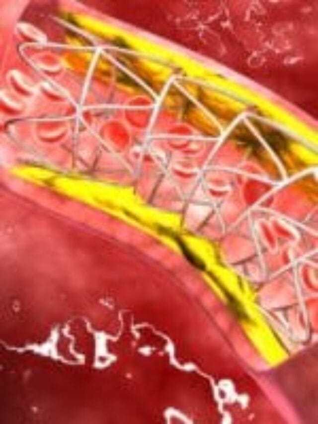 बॅड कोलेस्ट्रॉल कसे वाढते ? कसे कमी करायचे पाहा ?