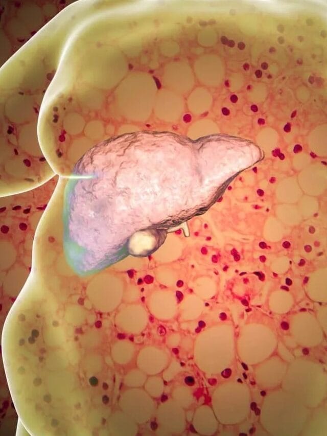 Fatty Liver ची समस्या असेल तर काय खाऊ नये ?