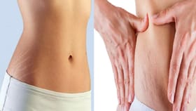 स्ट्रेच मार्क्स दूर करण्यासाठी घरच्या घरी करा 'या' सोप्य ट्रिक्स.....