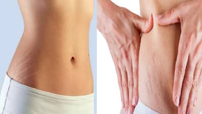 स्ट्रेच मार्क्स दूर करण्यासाठी घरच्या घरी करा या सोप्य ट्रिक्स....