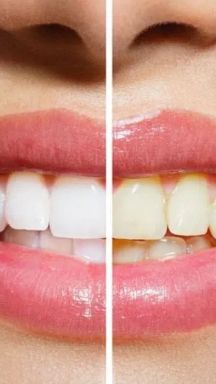 60च्या वयातही राहतील मजबूत दात; अशी घ्या काळजी