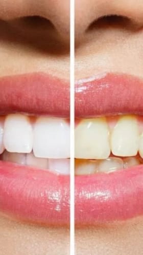 60च्या वयातही राहतील मजबूत दात; अशी घ्या काळजी