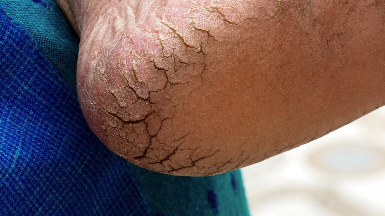 पाय कोरडे केल्यानंतर त्यावर खोबरेल तेल, एरंडेल तेल किंवा ऑलिव्ह ऑइलने मालिश करावी. व्हॅसलिनमध्ये लिंबाचा रस मिसळून लावल्यास भेगांवर लावल्यात त्या लवकर भरतात.