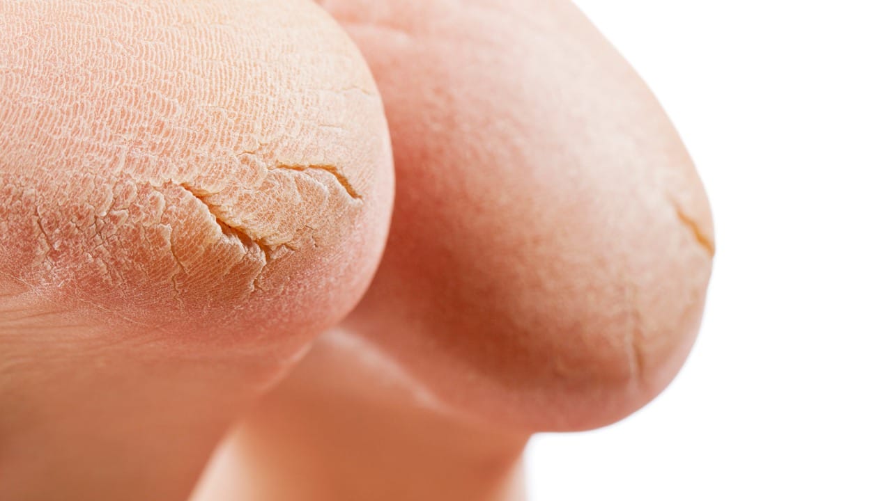 पाय भिजवल्यानंतर प्युमिस स्टोन (Pumice Stone) किंवा फूट स्क्रबरच्या मदतीने टाचांवरील मृत त्वचा हलक्या हाताने घासून काढावी. यामुळे भेगा भरून येण्यास मदत होते.