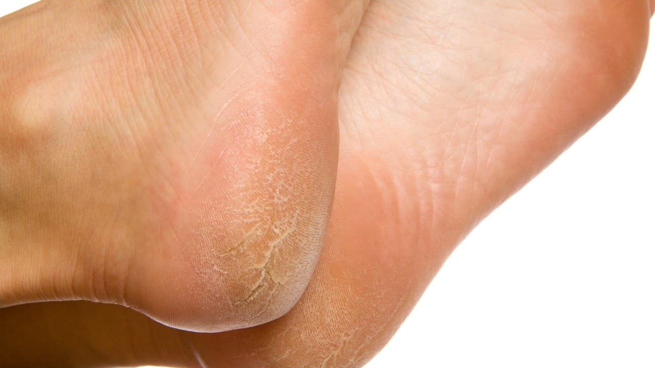 हिवाळ्यात किंवा कोरड्या हवामानामुळे टाचांना भेगा पडणे ही एक सामान्य समस्या आहे. या समस्येकडे दुर्लक्ष केल्यास वेदना आणि संसर्ग होऊ शकतो. टाचांच्या भेगांवर घरगुती उपायाबद्दल जाणून घ्या.