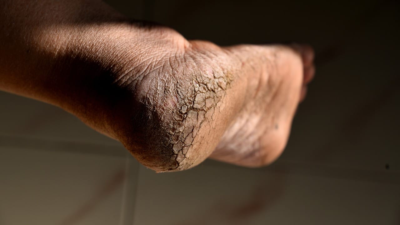 यातील कोणतेही उपाय केल्यानंतर टाचांवर क्रीम किंवा तेल लावून सुती मोजे (Cotton Socks) घालून झोपावे. यामुळे ओलावा टिकून राहतो. तसेच पाय लवकर बरे होतात.