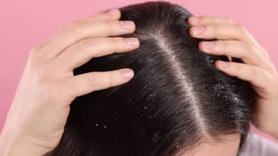 केस गळणं थांबेल, कोंड्याचीही समस्या होईल दूर फक्त खोबरेल तेलात मिक्स करा ही एक गोष्ट