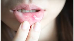 Mouth Ulcer: थंडीतही वारंवार येतंय तोंड? मग करा हा साधा उपाय.