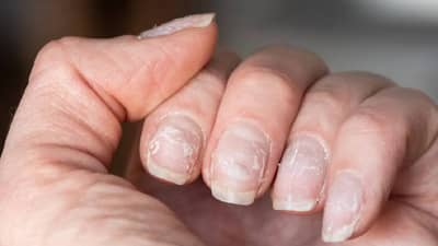 नखांच्या आरोग्याची स्थिती कशी ओळखायची? जाणून घ्या
