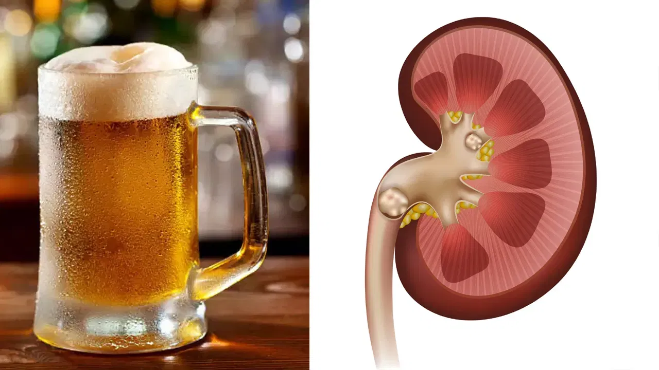 खड्याचा आकार महत्त्वाचा : जर किडनीतील खडा 5 मिमी पेक्षा मोठा असेल, तर तो कोणत्याही पेयाने आपोआप बाहेर पडू शकत नाही. अशा वेळी बिअरमुळे लघवीचा दाब वाढल्यास तो खडा नळीत (Ureter) अडकून तीव्र वेदना होऊ शकतात.