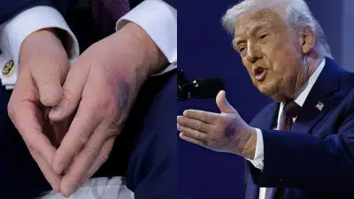 डोनाल्ड ट्रम्प यांना नेमकं काय झालं? आजार किती गंभीर? मोठी हेल्थ अपडेट समोर