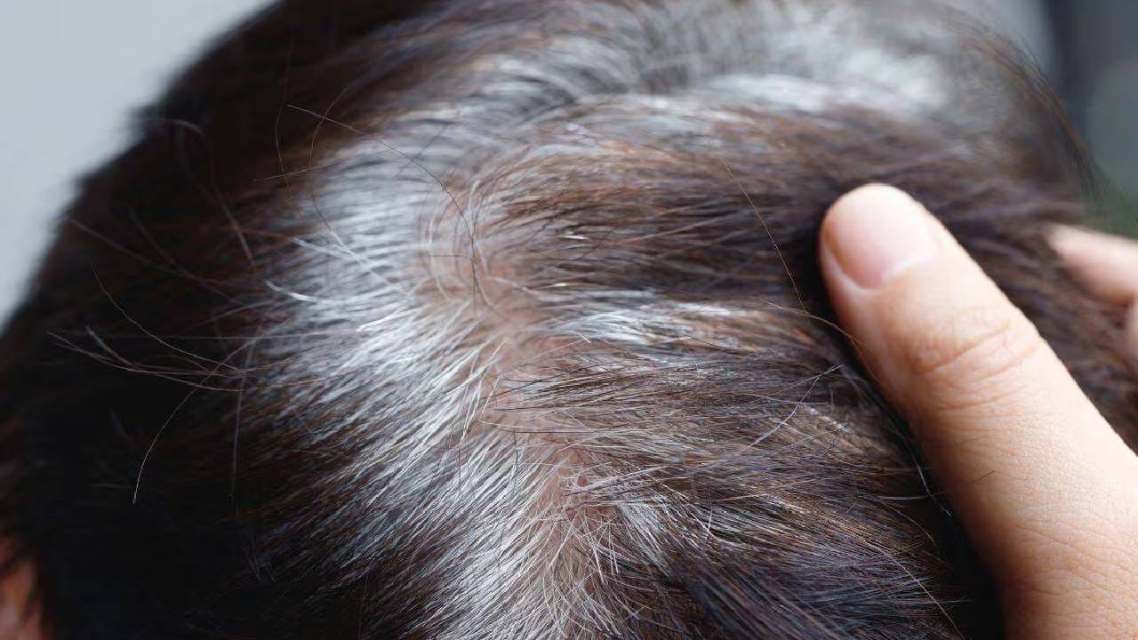 पांढरे केस होणे टाळण्यासाठी आणि केस गळती थांबवण्याकरिता काही महत्वाच्या गोष्टी आहेत, ज्या आपण फॉलो केल्याने या समस्या कायमच्या दूर राहतील.