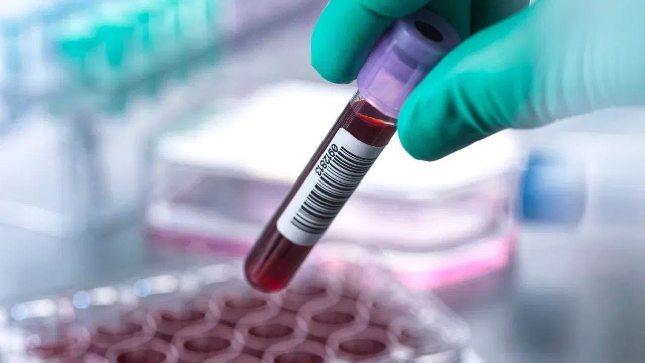 हळदीचे दूध पिल्याने त्यांच्या आरोग्याच्या समस्या अधिक वाढू शकतात. रोगप्रतिकारक शक्तीवरही त्याचा थेट परिणाम होऊ शकतो, ज्यामुळे हे टाळा. 